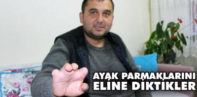 Ayak parmakları eline nakledildi