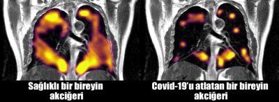 İşte Covid 19 geçiren ve geçirmeyen kişilerin akciğerleri arasında ki fark