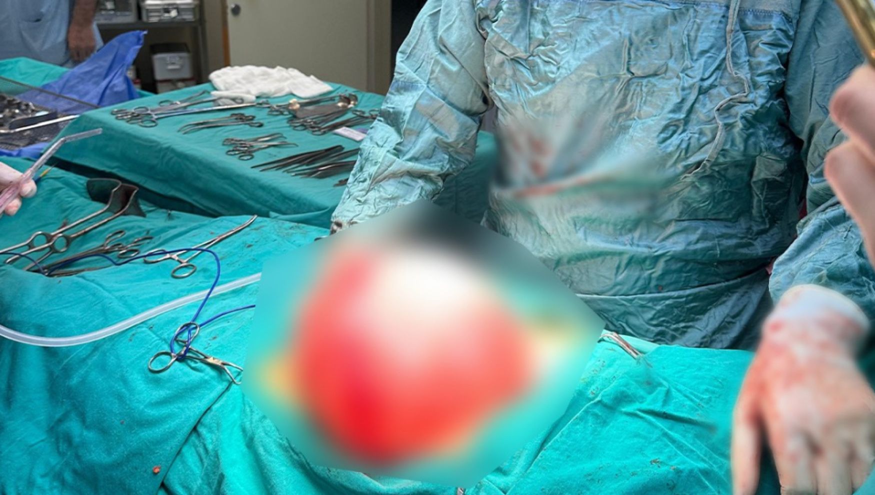 14 yaşındaki öğrencinin karnından 3,5 kiloluk kist çıkarıldı